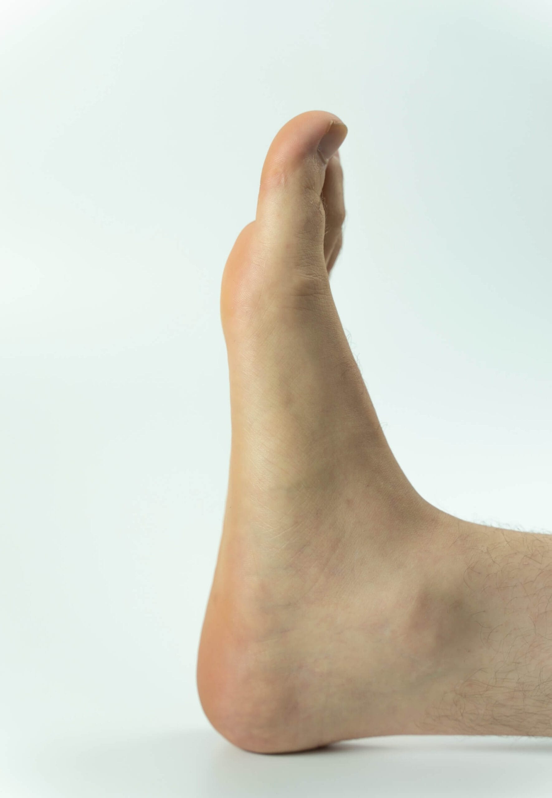 Düz Tabanlık (Pes Planus) hastalıklı bir ayak