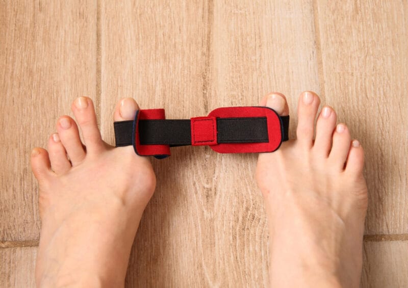 Başparmak Çıkıntısı için tedavisi uygulanan ayaklar