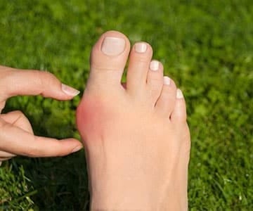 ayak sagliginda gorulen en sik sorunlar halluks valgus m