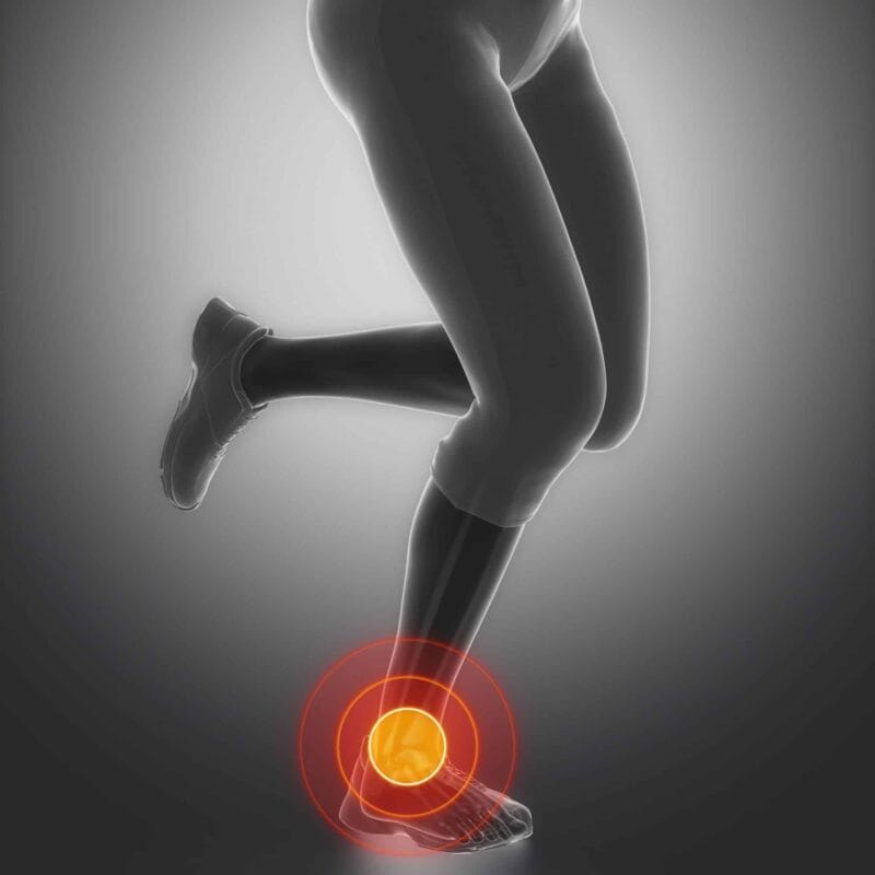 aşil tendonu bölgesini gösteren bir görsel