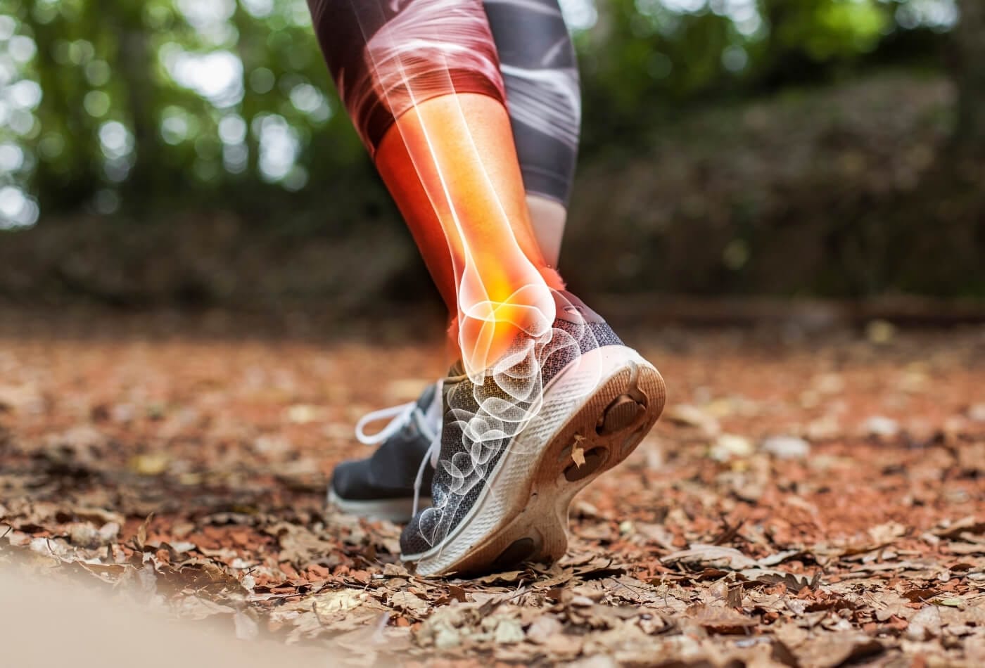 Yürüyüşü sırasında Ayağının Aşırı Kullanımına Bağlı olarak yaralanma yaşayan bir kişi