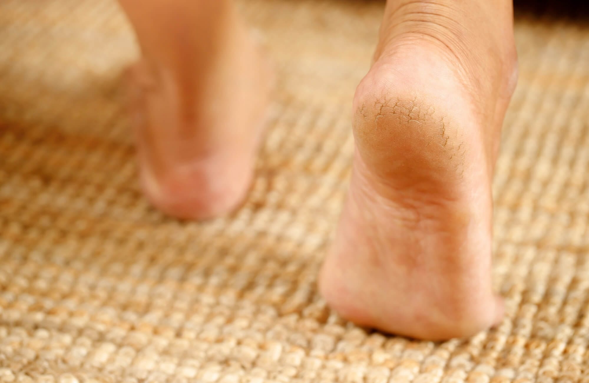 Çukur Taban Hastalığının Nedenleri, Teşhisi ve Tedavisi 2 Çukur taban sorunu yaşayan bir ayak