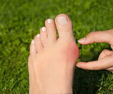 Ayak Kemiği Çıkıntısı Nedir? 2 halluks