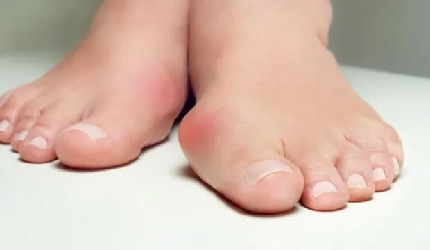 Ayak kemiği çıkıntısı nedir?