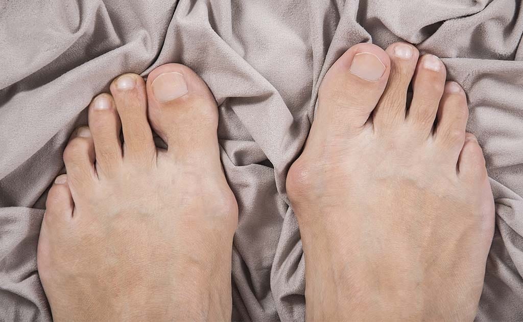 Başparmak Çıkıntısı Hayatınızı Etkilemesin! 1 Başparmak çıkıntısı sorunu yaşayan ayaklar