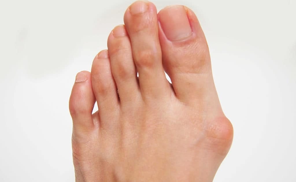 Bunyonların Sebepleri