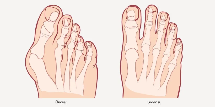Halluks Valgus’da Yeni Gelişme: Minimal İnvaziv 2 halluks valgus cerrahisi nasil yapilir