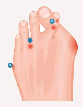 parmak parmak üstüne binmesi örneği