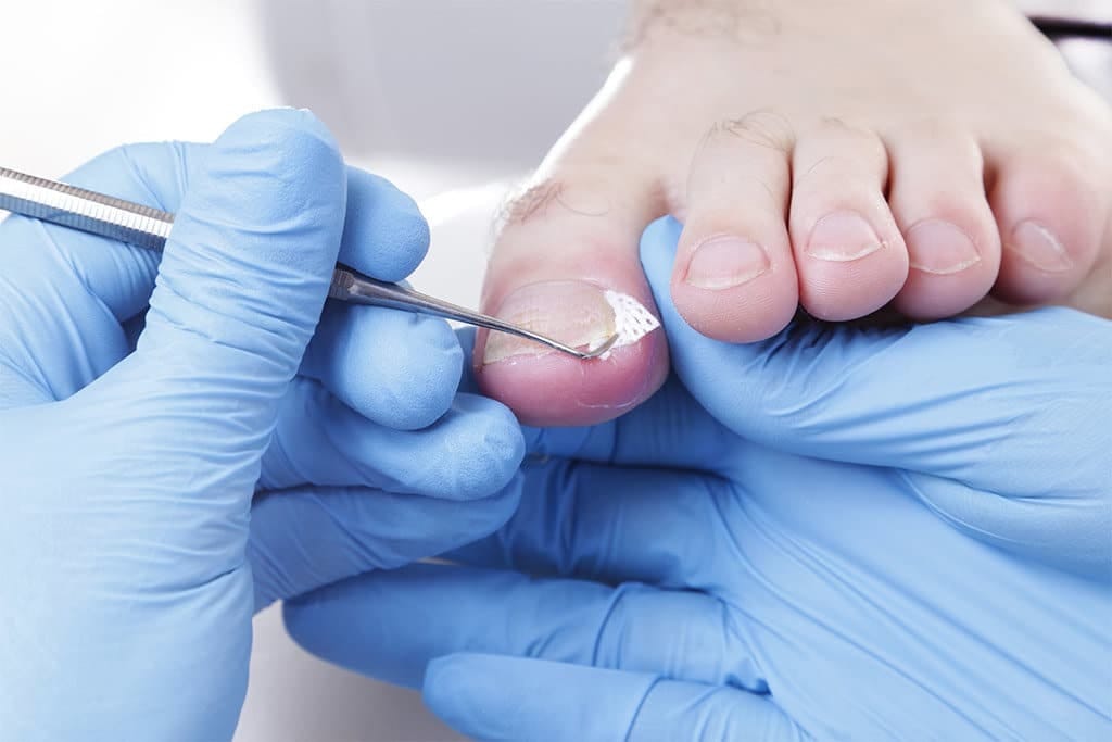 batık tırnak problemleri