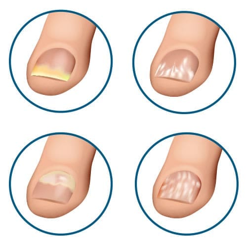 Tırnak Mantarı Tedavisi Nedir? 2 farklı Tırnak Mantarı çeşitleri görseli