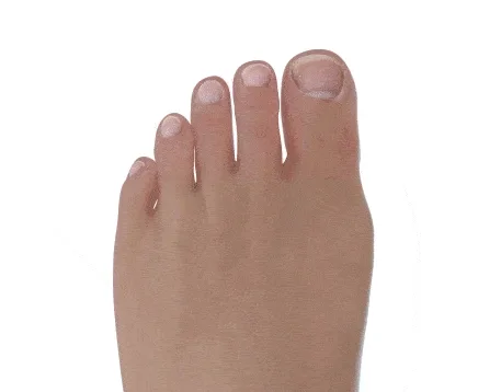 Halluks Valgus Animasyonu