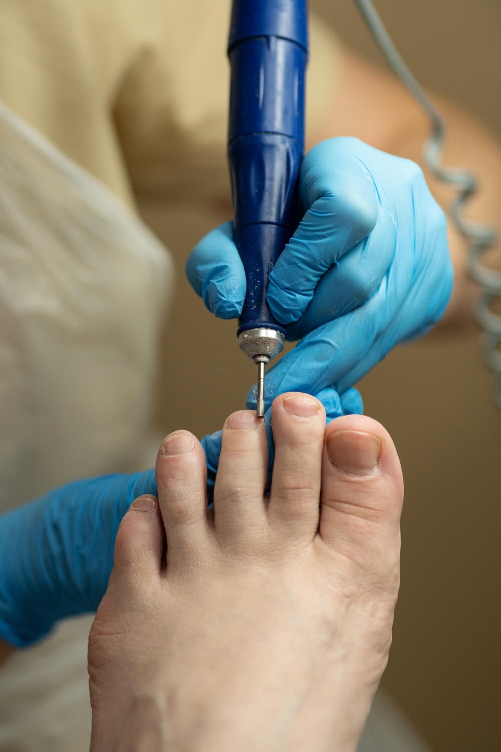 Ayak Tırnağı Kalınlaşması sorunu olan bir ayak tedavi ediliyor