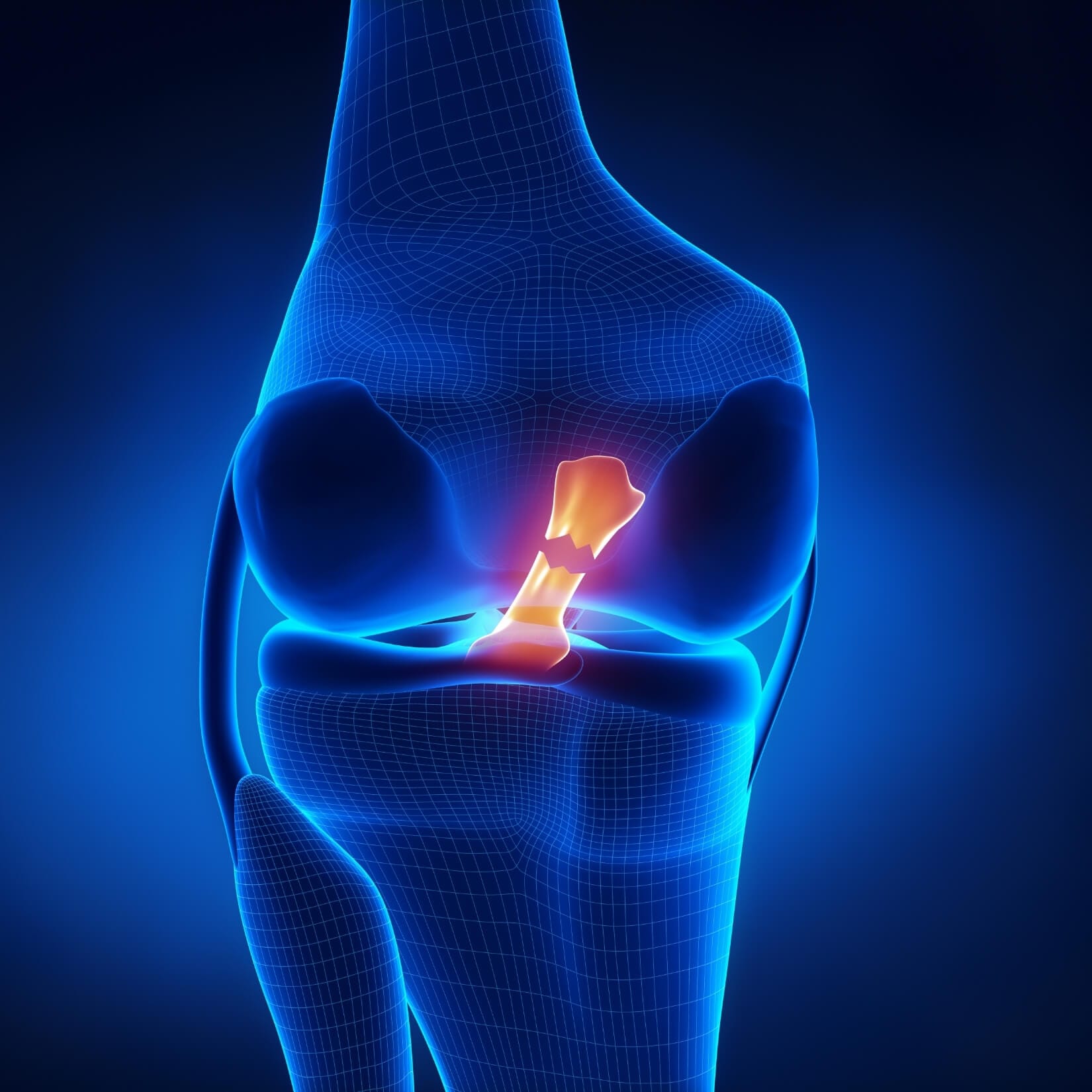 Menisküs Yırtığı X-Ray görüntüsü