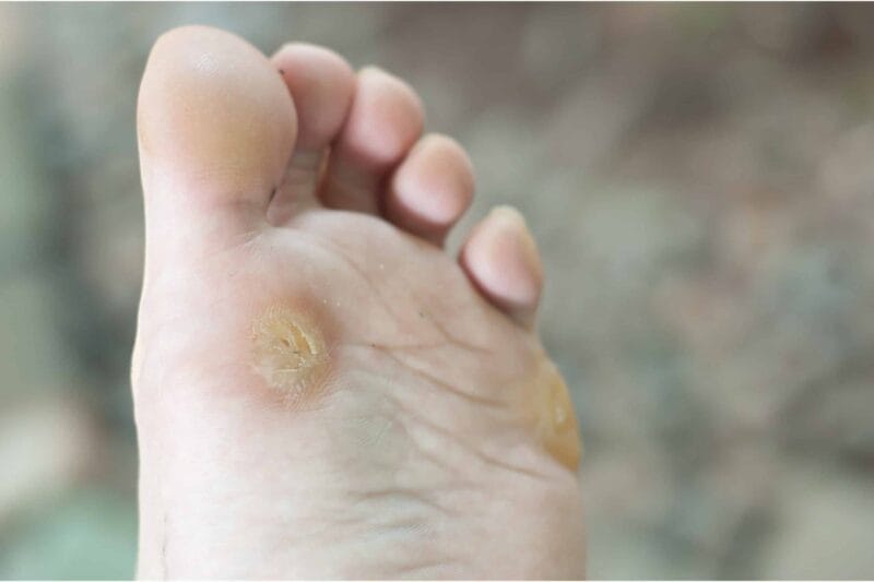 ayak tabanında siğil nasıl oluşur?
