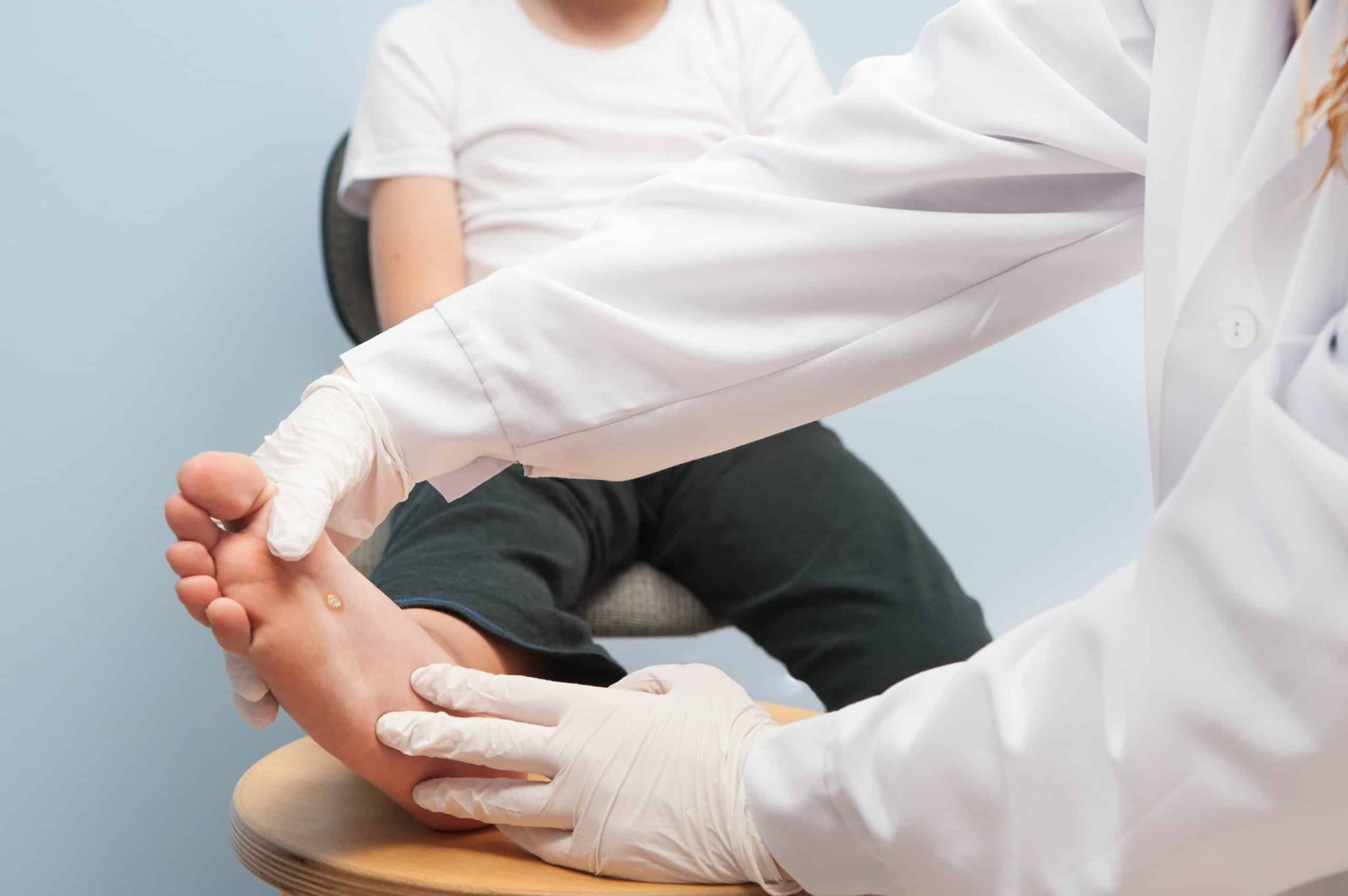 Ayakta siğil probleminin tedavisi