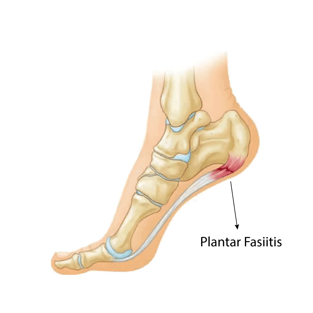 plantar fasitiss - topuk ağrısı problemini tanımlayan bir görsel