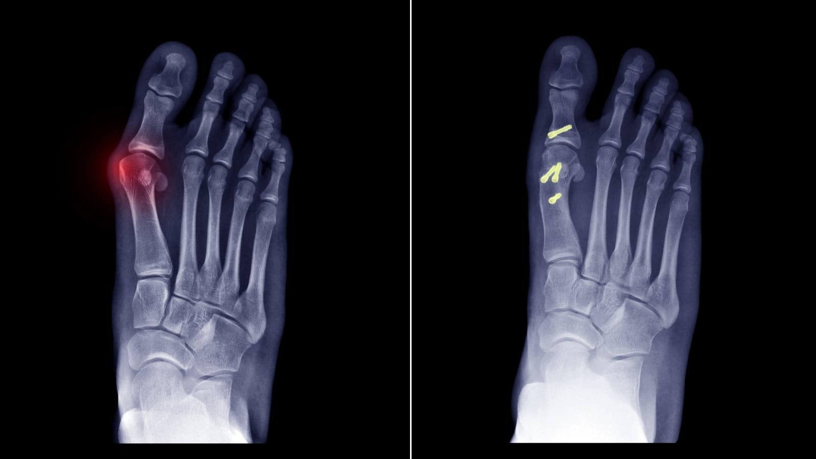 Halluks Valgus Oncesi Sonrasi X-ray
