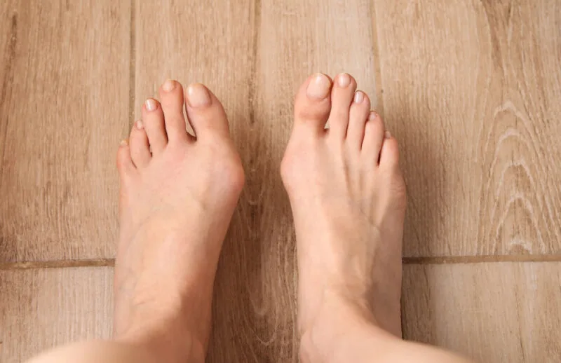 Her iki ayakta belirgin halluks valgus (ayak başparmak çıkıntısı) deformitesini gösteren üstten çekilmiş fotoğraf