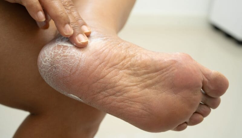 Topuk Catlagi Neden Olur Yaz ve Kis Mevsimine Gore Topuk Bakimi Rehberi blog gorseli 02